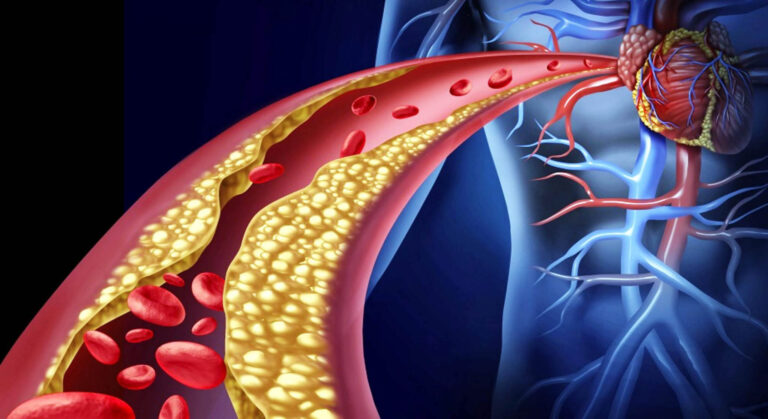 Αθηροσκλήρωση: Η ύπουλη πάθηση που μας γερνά πιο γρήγορα
